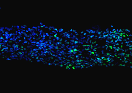 Image: Tissue section of a human tumor sliced from a tissue culture. The tissue was cut in special process into thin slices and then stained with various dyes, (green: growing cells, blue: nuclei). (Photo courtesy Institute of Anatomy University of Leipzig / F. Merz).